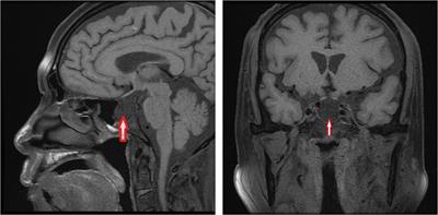 Autoimmune Hypophysitis With Systemic Lupus Erythematosus: A Case Report and Literature Review